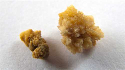 得了痛风常见哪些症状?痛风发作持续数天可自行缓解吗?